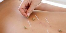 acupuncture in Hatfield