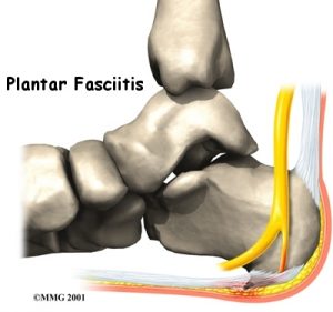 foot_plantar_fasciitis Kettering Osteopath