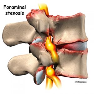 lumbar_low_back_pain_Kettering Osteopath