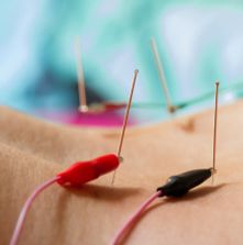 Electroacupuncture for overactive bladder