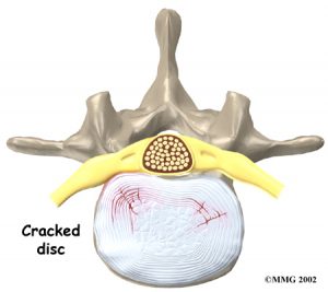 lumbar_low_back_pain_Kettering Osteopath