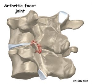 lumbar_low_back_pain_Kettering Osteopath