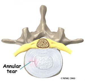 lumbar_low_back_pain_Kettering Osteopath