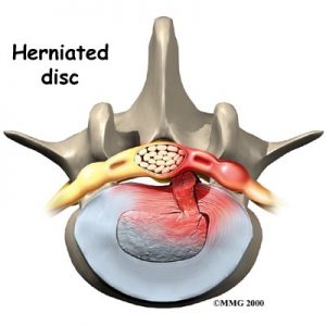 lumbar_low_back_pain_Kettering Osteopath