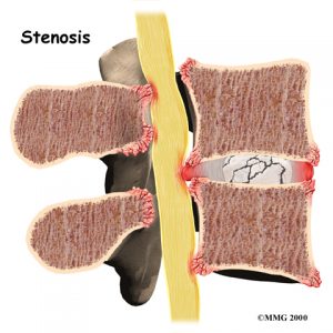 lumbar_low_back_pain_Kettering Osteopath