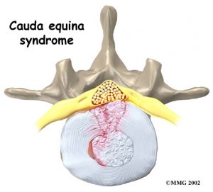 lumbar_low_back_pain_Kettering Osteopath