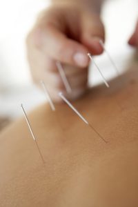 acupuncture