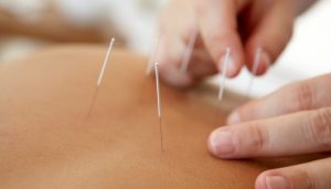 Acupuncture and Chinese Herbal Medicine in Kettering Northamptonshire