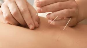 Acupuncture and Chinese Herbal Medicine in Kettering Northamptonshire